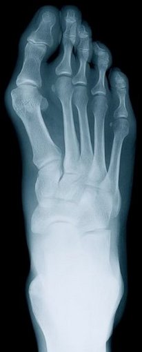 Vestavia Hills Podiatrist | Vestavia Hills Rheumatoid Arthritis | AL | Alabama Foot Institute |